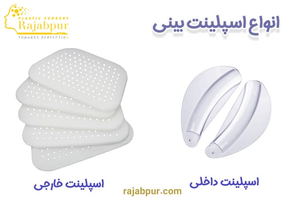 انواع اسپلینت بینی