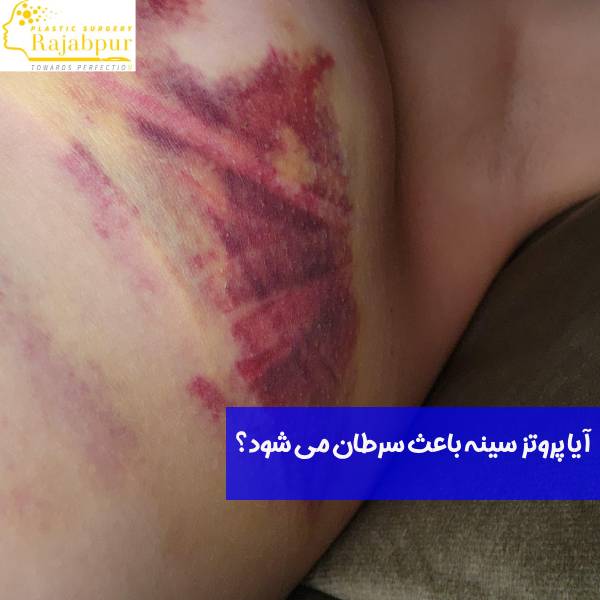 ابتلا به سرطان سینه در اثر پروتز
