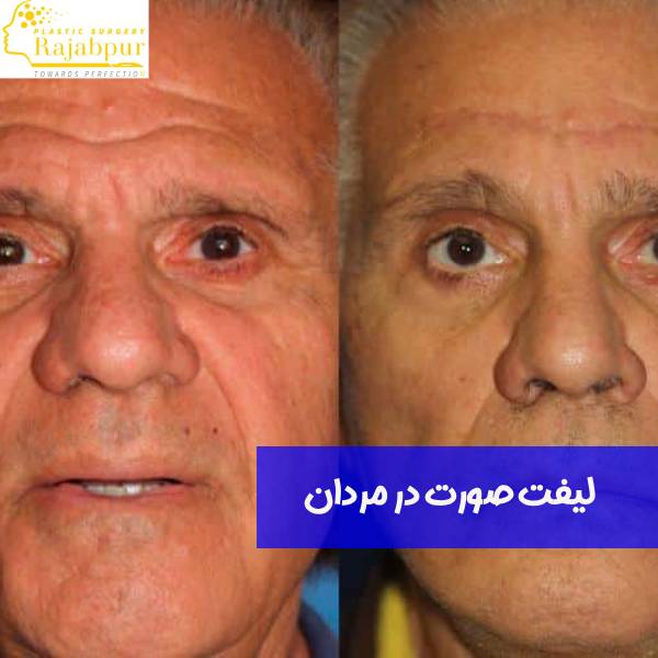 لیفت صورت در مردان