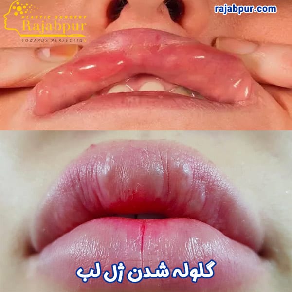 گلوله شدن ژل لب - دکتر رجبپور