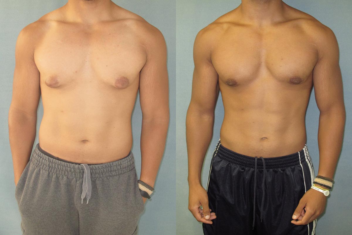 از بین رفتن چربی سینه در مردان