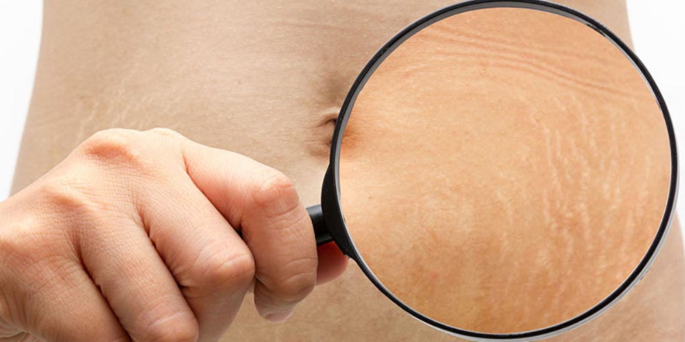 استرچ مارک چیست