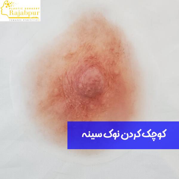 عمل نوک سینه 