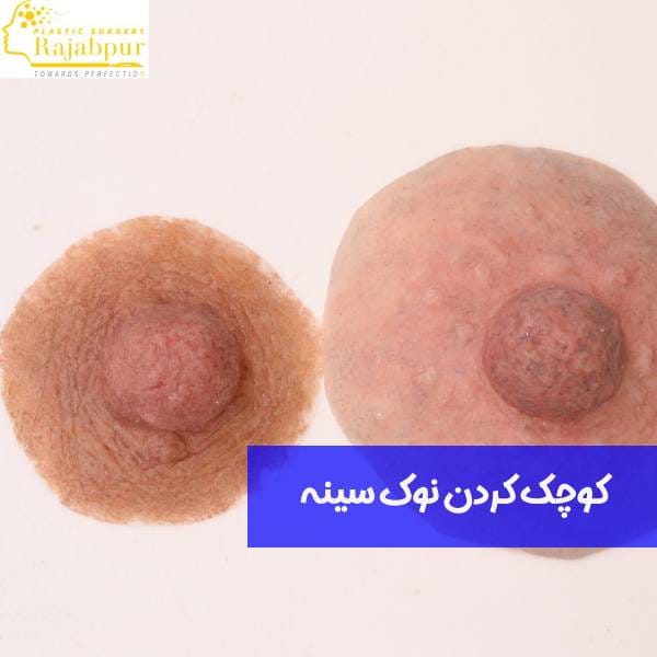 عمل نوک سینه 