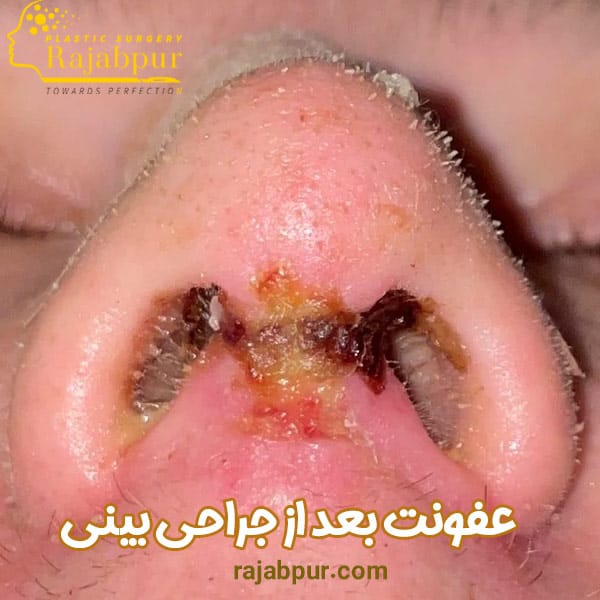 عفونت بعد از جراحی بینی - دکتر رجبپور
