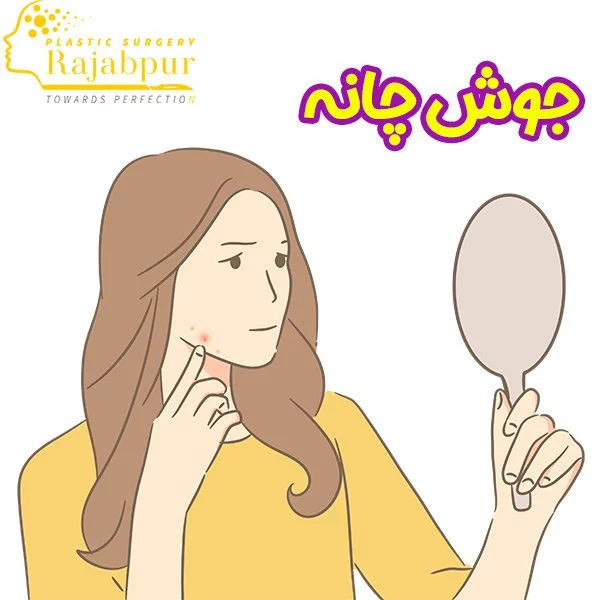 جوش چانه + دکتر رجب پور