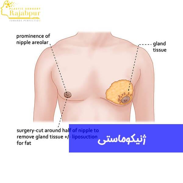 ژنیکوماستی کاذب