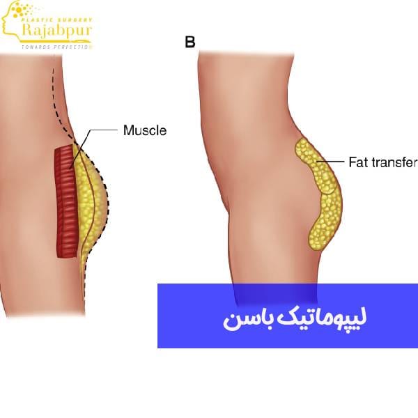لیپوماتیک باسن