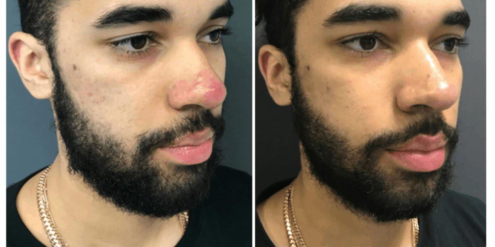 جوش صورت بعد از عمل بینی - دکتر رجب پور