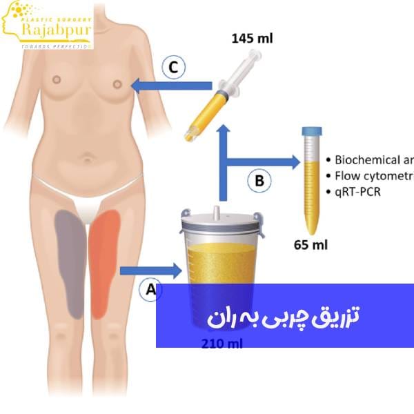 تزریق چربی به ران