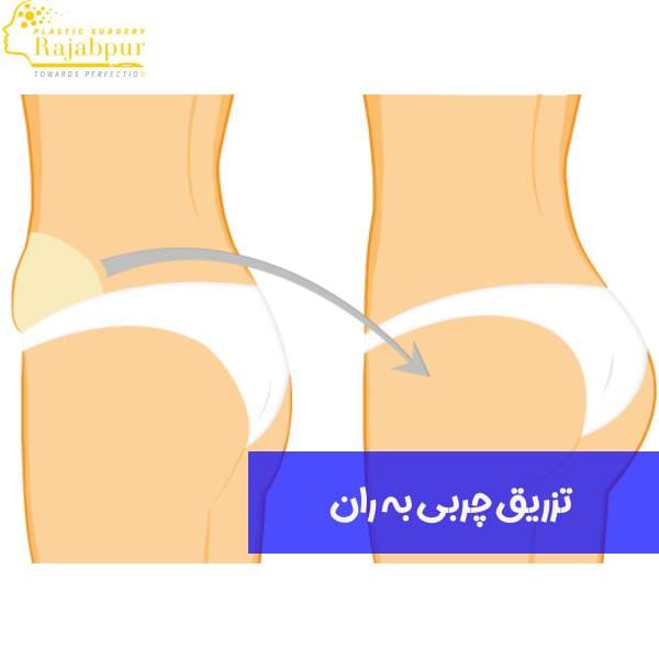 تزریق چربی به ران