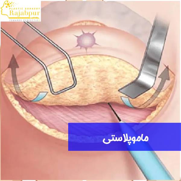 ماموپلاستی