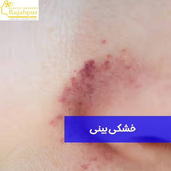 خشکی بینی بعد از جراحی