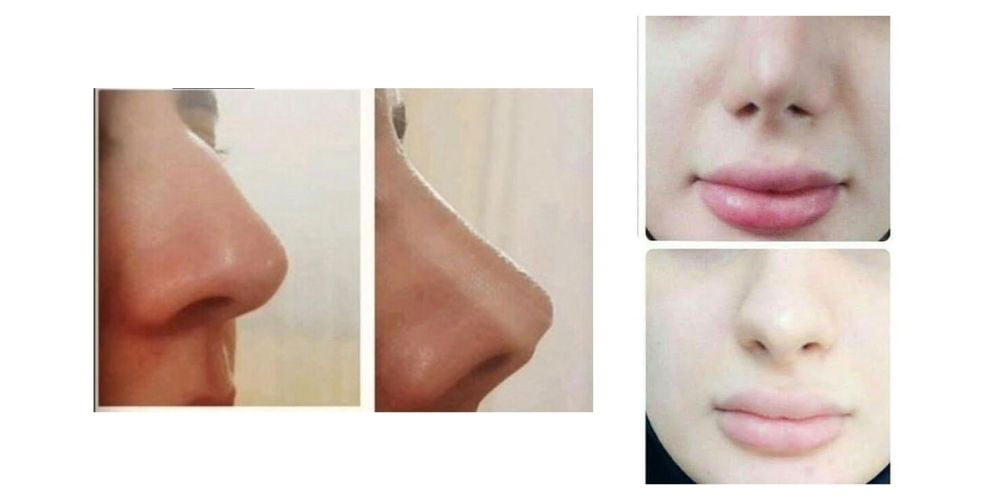 عوارض چسب لیفت بینی