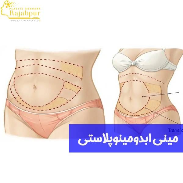 مینی ابدومینوپلاستی