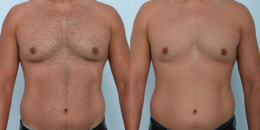 مراقبتهای بعد از عمل ژنیکوماستی