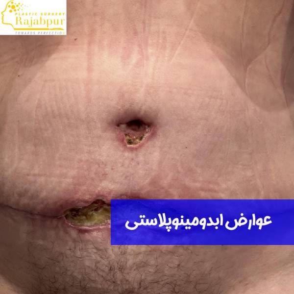 خطرات عمل ابدومینوپلاستی