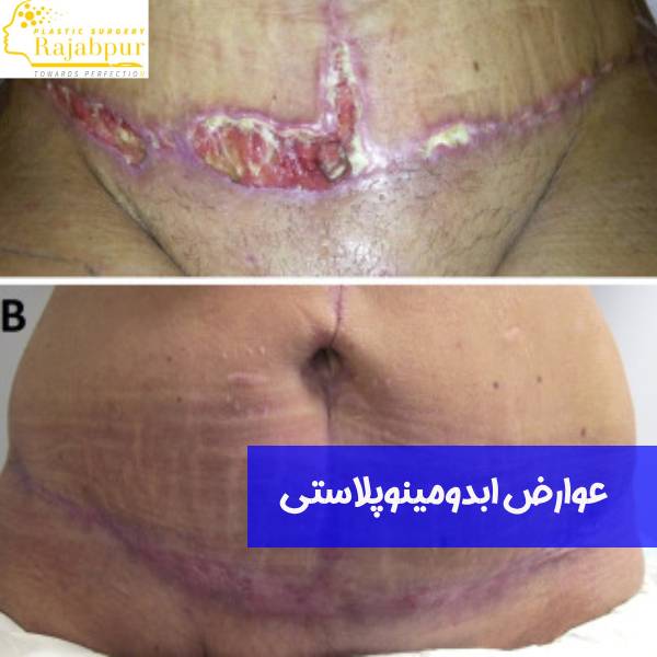 عوارض ابدومینوپلاستی