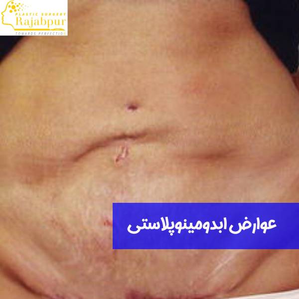 عوارض عمل ابدومنیوپلاستی