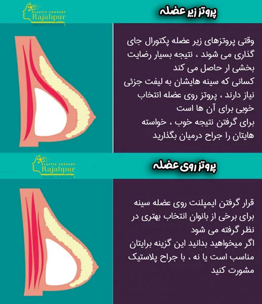 فیلم عمل پروتز سينه زیر عضله+پروتز سینه سایز ۸۵