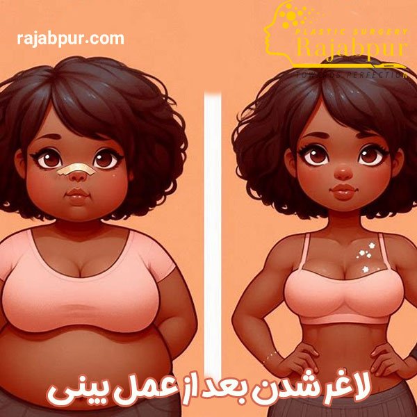 لاغر شدن بعد از عمل بینی - دکتر رجب پور