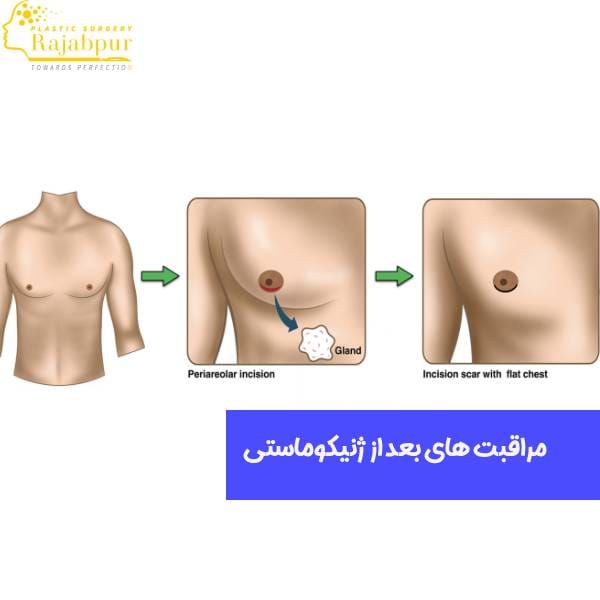 مراقبت های بعد از ژنیکوماستی