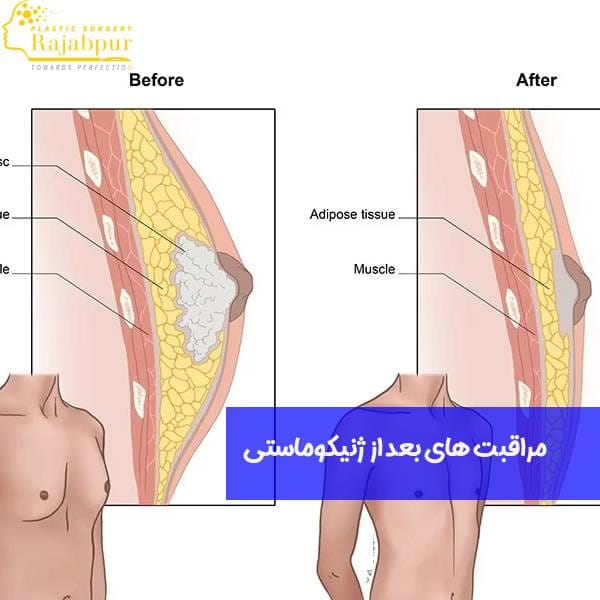مراقبت های بعد از ژنیکوماستی