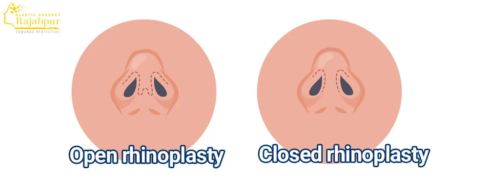 روش های جراحی بینی