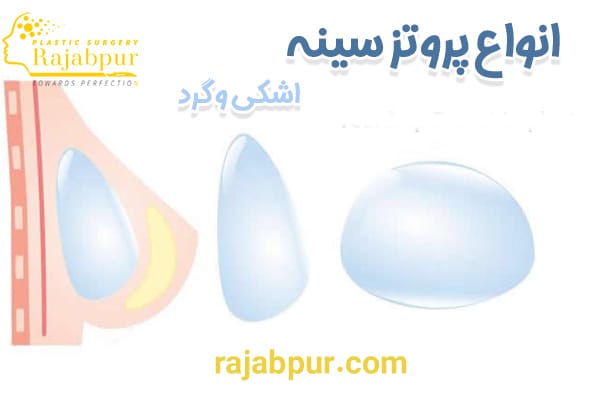 انواع پروتز سینه - دکتر رجب پور