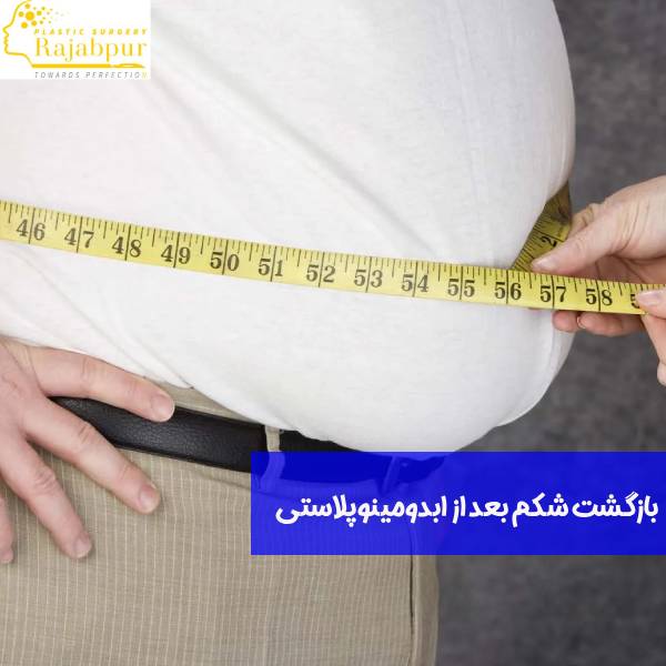 بازگشت شکم بعد از ابدومینوپلاستی