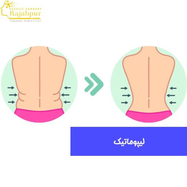 عکس لیپوماتیک