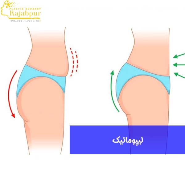 عمل لیپو
