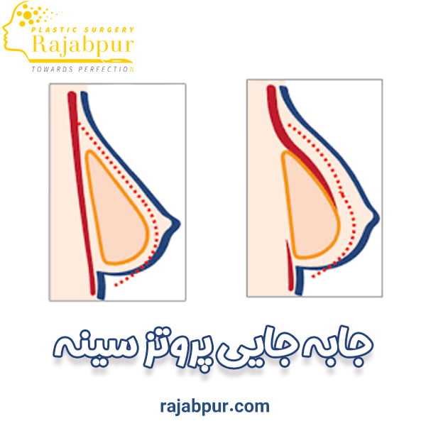 جا بجایی پروتز سینه - دکتر رجب پور
