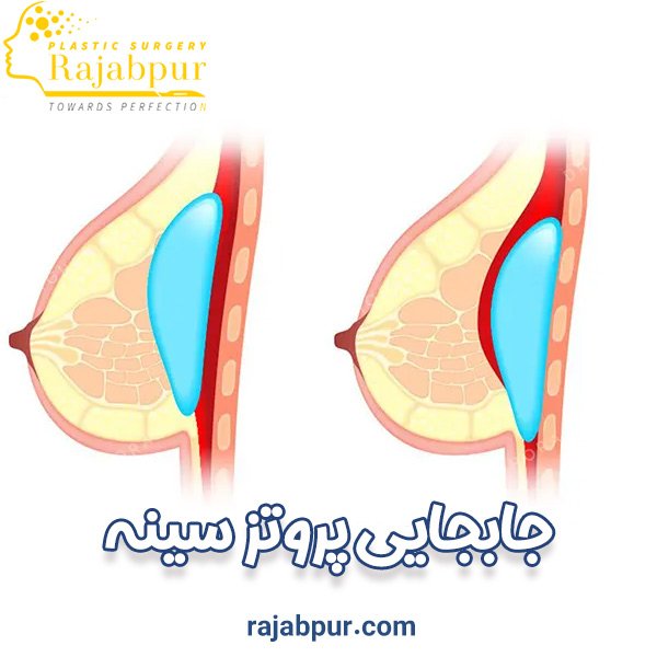 جا بجایی پروتز سینه - دکتر رجب پور