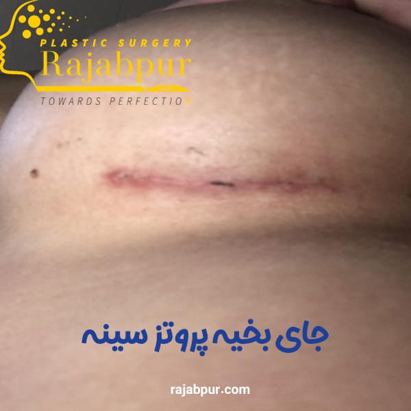 بخیه های پروتز سینه - دکتر رجب پور