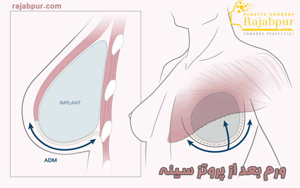 ورم سینه بعد از پروتز