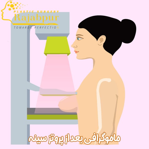 عکس ماموپلاستی بعد از پروتز سینه