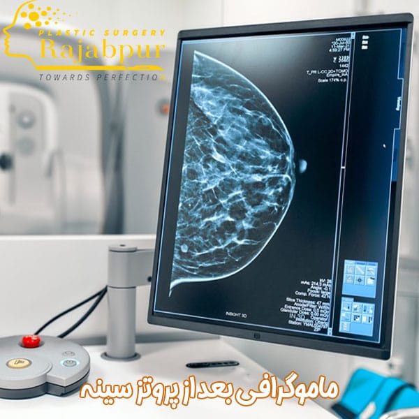 زمان ماموگرافی