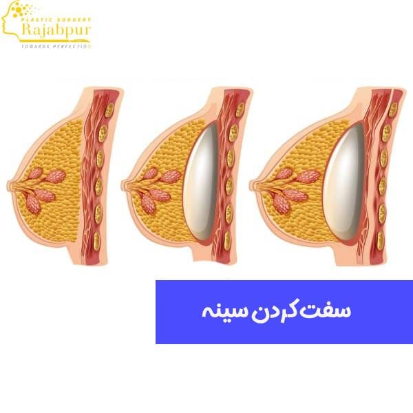 سفت کردن سینه