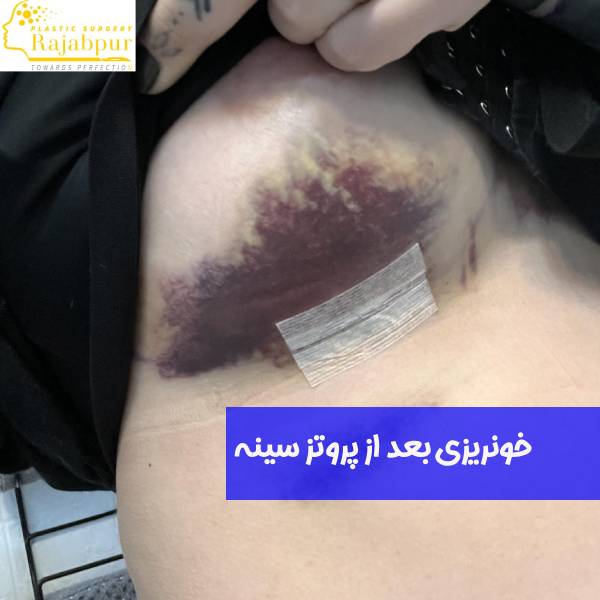 خونریزی بعد از پروتز سینه