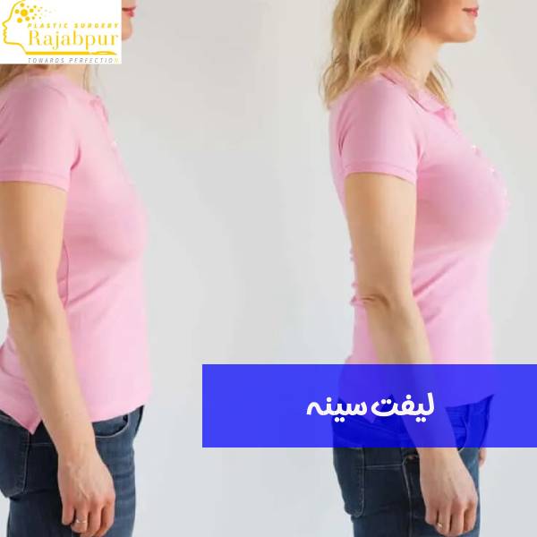 لیفت سینه