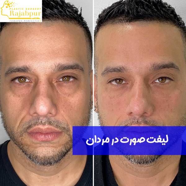 لیفت صورت در مردان