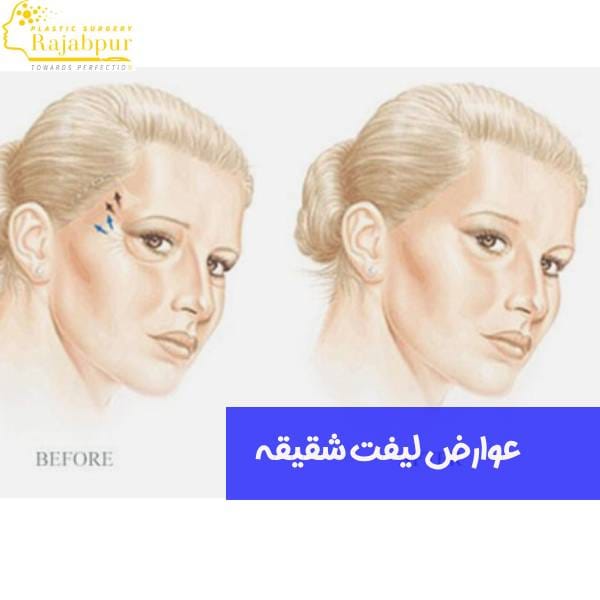 عکس عوارض لیفت شقیقه