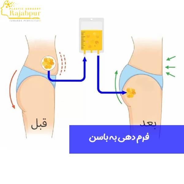 عمل فرم دهی به باسن