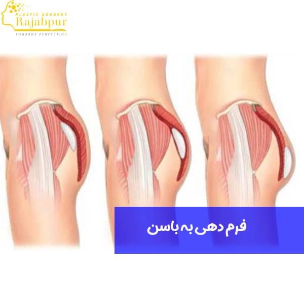 روشهای فرم دهی به باسن