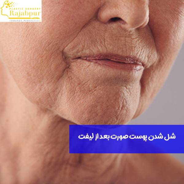 شل شدن پوست بعد از لیفت