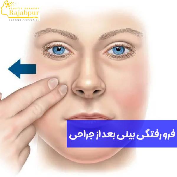 فرو رفتگی بینی بعد از عمل