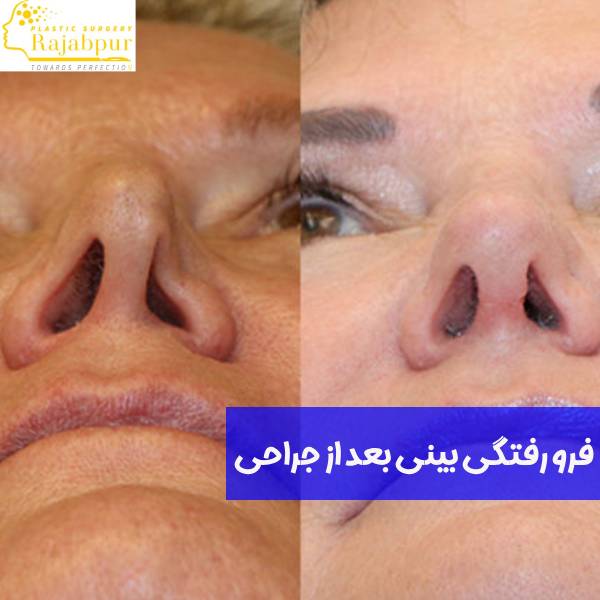 فرو رفتگی بینی بعد از جراحی