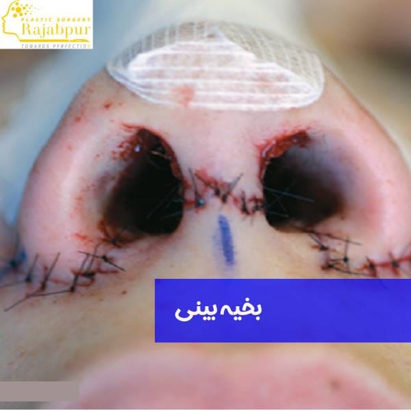 رد بخیه بینی
