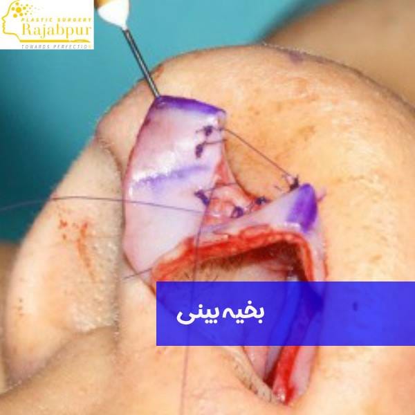 بخیه بینی بعد از جراحی